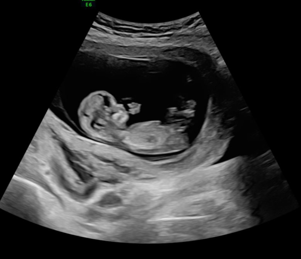 12 week ultrasound photo